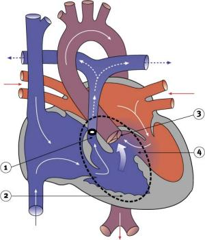 Tetralogy of Fallot